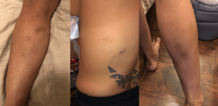 Cortez's knees, back, and legs were left sore and bruised when officers restrained her. Images courtesy Liliana Cortez